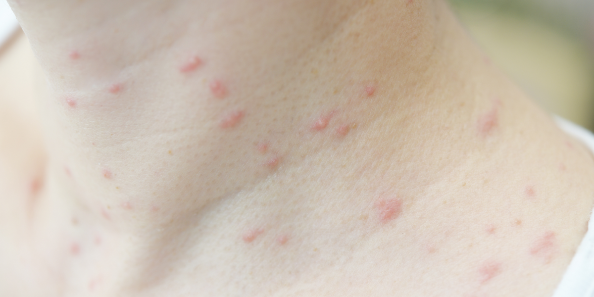 4.脂漏性皮膚炎