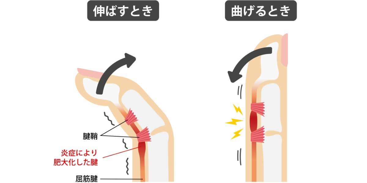 ドケルバン病(狭窄性腱鞘炎)